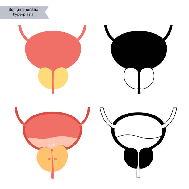 Prostate Problems Graphics 200+ Enlarged Prostate Stock Illustrations, Royalty-Free Vector ...