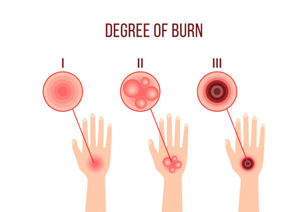 illustrations, cliparts, dessins animés et icônes de infographies de différents degrés de brûlure - second skin