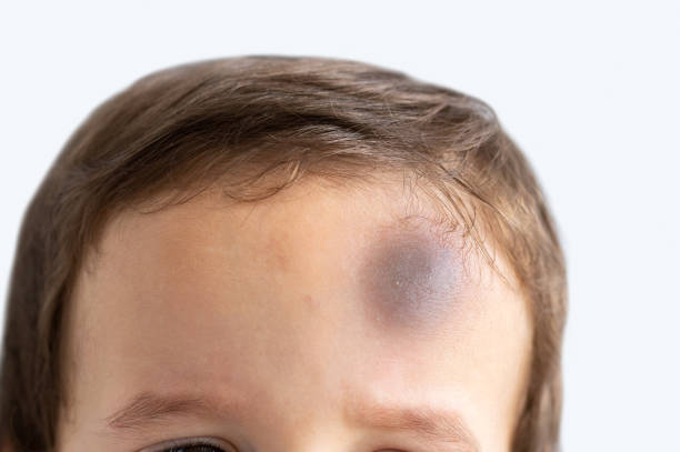 child with bump on the forehead Close-up of a boy with injury on head bruise stock pictures, royalty-free photos & images