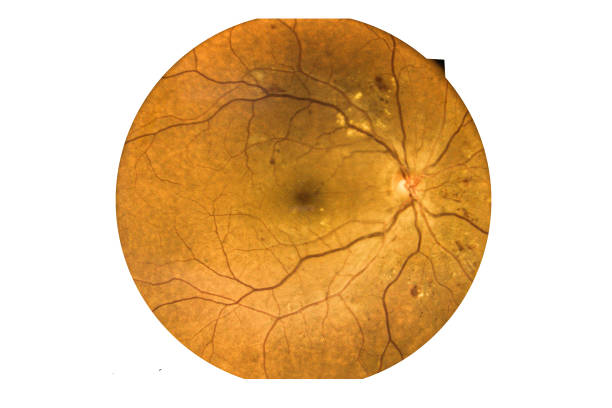 istock Fundus photography Madical Retina Abnormal isolated on white background 1284050894