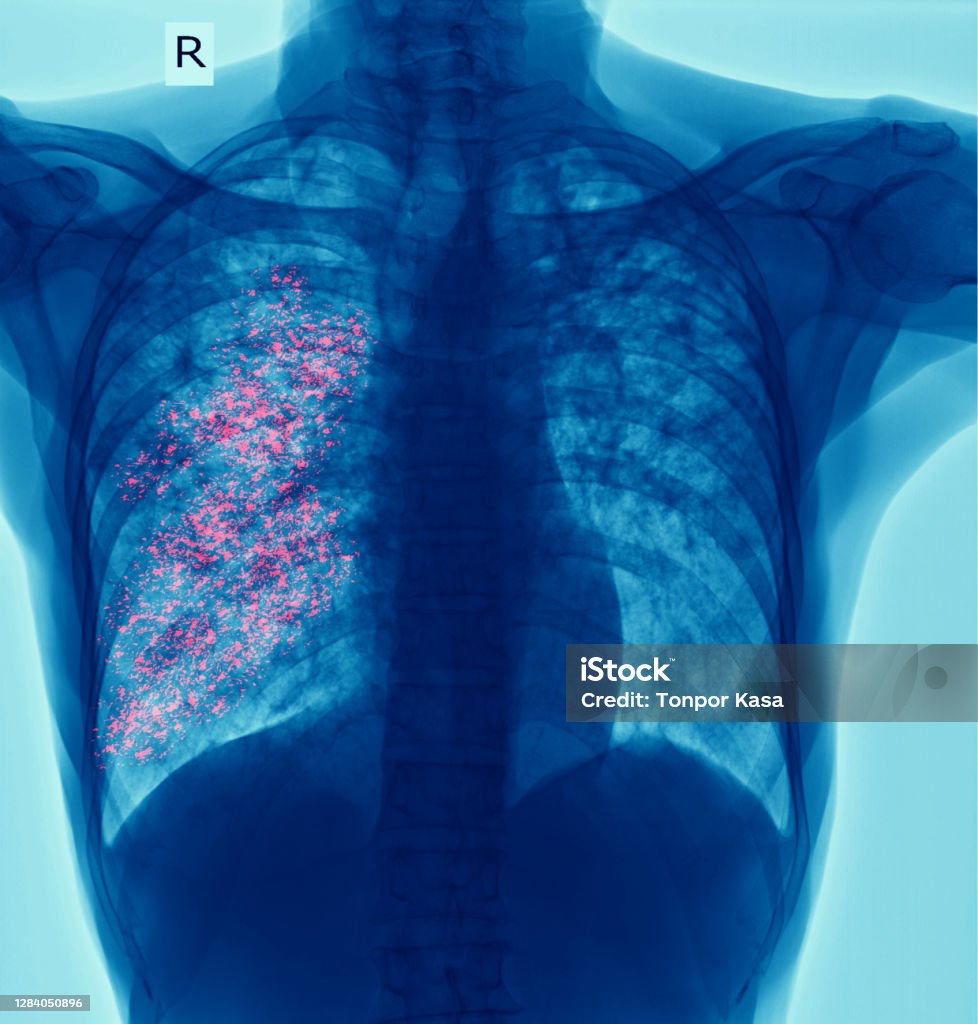 x-ray chest showing  cavity at right lung and interstitial infiltrate both lung due to TB infection,Pulmonary tuberculosis Chest x-ray  showing  cavity at right lung and interstitial infiltrate both lung due to TB infection,Pulmonary tuberculosis Tuberculosis Bacterium Stock Photo