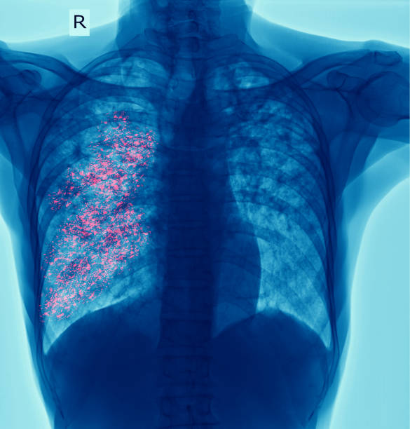 klatki piersiowej x-ray pokazano jamy w prawym płucu i śródmiąższowe nacieki zarówno płuc z powodu zakażenia gruźlicą, gruźlicy płuc - interstitial zdjęcia i obrazy z banku zdjęć