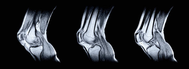 右膝の磁気共鳴画像法(mri)関節関節の閉じた傷害、関節症の症状 - globe joint ストックフォトと画像