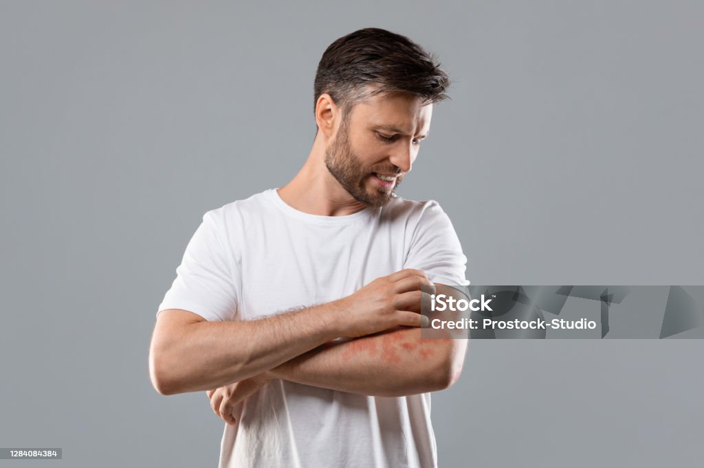 Annoyed man scratching itch on his arm Dermatitis, eczema, allergy, psoriasis concept. Annoyed middle-aged man in white t-shirt scratching itch on his arm, grey studio background. Bearded man itching rash on his elbow, copy space Psoriasis Stock Photo