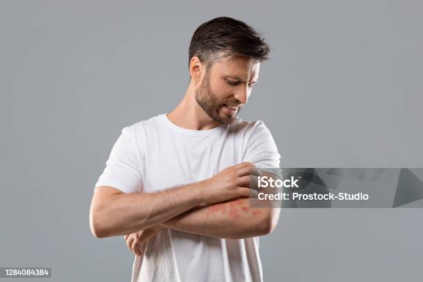 Annoyed Man Scratching Itch On His Arm Stock Photo - Download Image Now - Psoriasis, Skin, Allergy