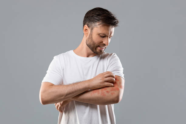 homem irritado coçando coceira em seu braço - dermatitis dry human hand human skin - fotografias e filmes do acervo