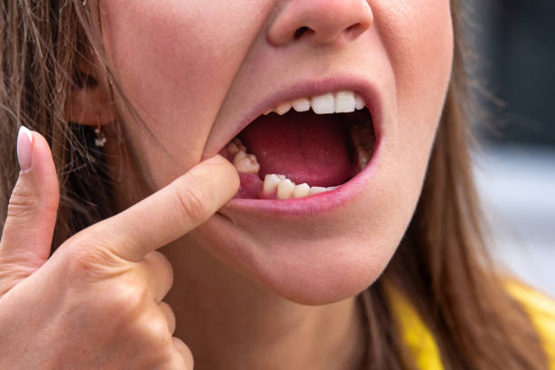 mujer joven sin diente en la mandíbula inferior. falta diente. esperar un implante después de la extracción dental - diente humano fotografías e imágenes de stock