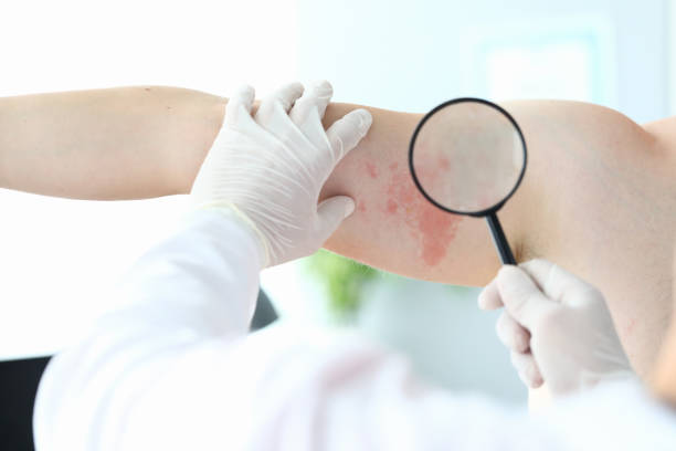 istock Gloved doctor looking at rash with magnifier 1284096673