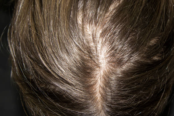 Thinning Hair On Head Of Woman Top View A Head Of Woman With Hair Loss  Stock Photo - Download Image Now - iStock
