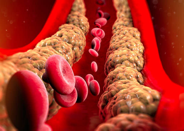 Cholesterol formation, fat, artery, vein, heart. Red blood cells, blood flow. Narrowing of a vein for fat formation stock photo