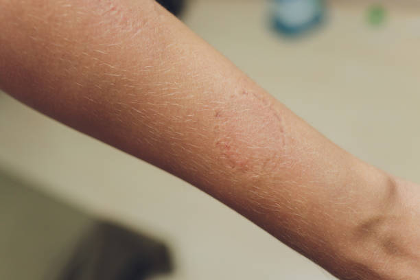 istock Toddler's bite marks on mothers arm - aggressive toddlers behavior psychology. 1284308430