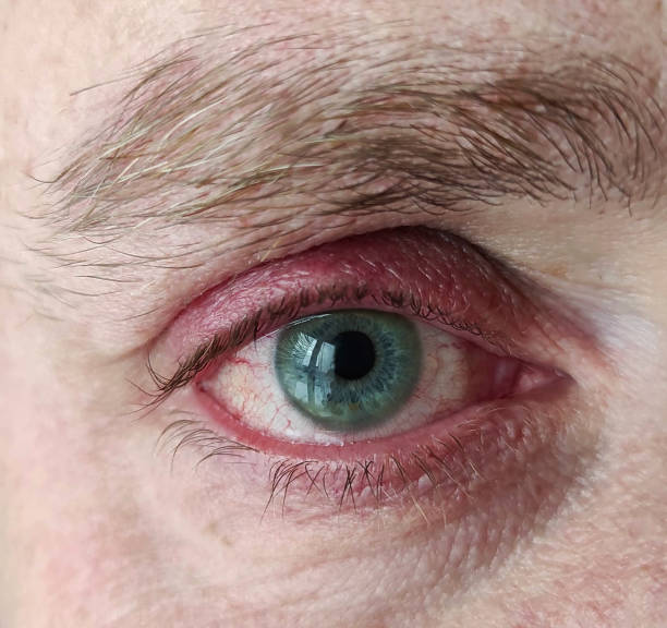 ウイルス性眼瞼炎、結膜炎、またはインフルエンザ、風邪またはアレルギーの後に影響を受ける男性の嫌な赤血の目をクローズアップ。健康、病気、治療の概念。眼に刺激を受けたり、感染� - dry skin close up horizontal macro ストックフォトと画像