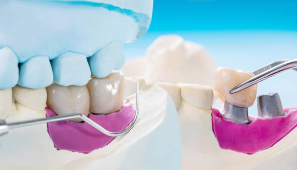 istock Implant Prosthodontics or Prosthetic 1284660189