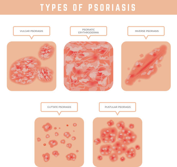 illustrations, cliparts, dessins animés et icônes de types de psoriasis. problèmes de peau fermer les illustrations médicales ensemble vectoriel - psoriasis