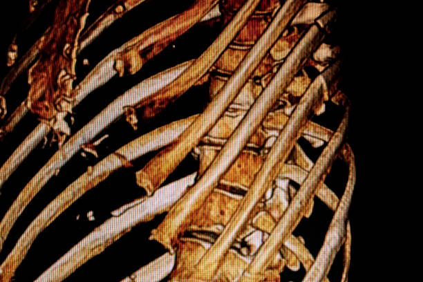cat -scan della frattura della costola - human bone forensic science medical scan morphology foto e immagini stock