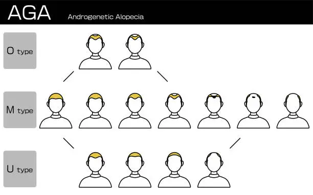 Vector illustration of Illustration of each type of AGA androgenetic alopecia and progress stage