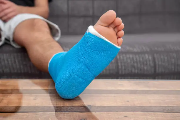 Photo of Close up of male foot in plaster cast with blue splint.