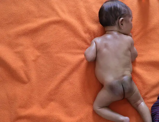 a prone infant lying on his belly showing birth mark mongolian spot in his buttock. view from top.