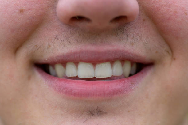 istock Close up on the teeth of a smiling young man 1285096571