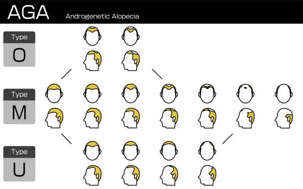 Vector illustration of Illustration of each type of AGA androgenetic alopecia and progress stage