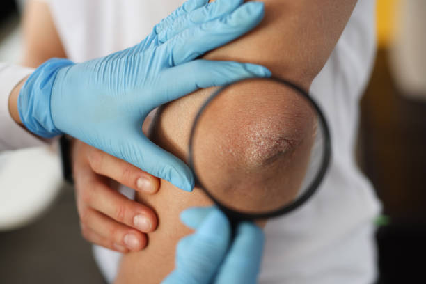 Doctor with rubber gloves examining patient's elbow using magnifying glass in clinic Doctor with rubber gloves examining patient's elbow using magnifying glass in clinic. Psoriasis diagnosis concept psoriasis stock pictures, royalty-free photos & images