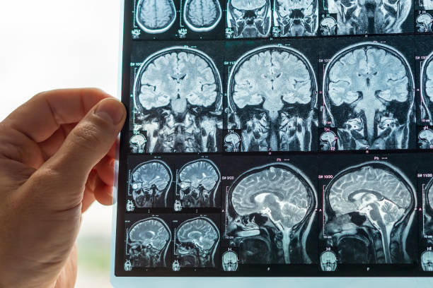 istock The doctor analyzes an MRI image of the brain 1285112572