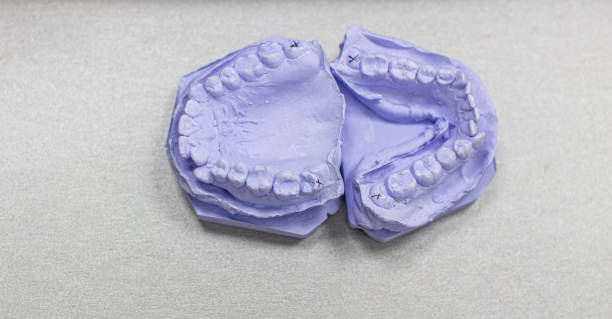 yeso fundido de dientes de yeso en el ortodoncista. - technician dentures prosthetic equipment workshop fotografías e imágenes de stock