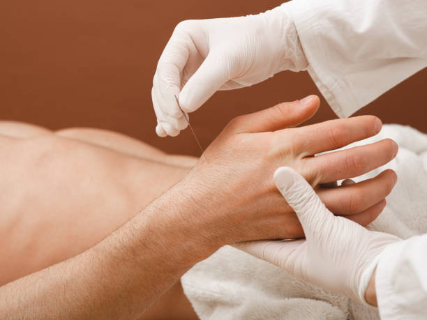 Reflexologist insert an acupuncture needle into a patient's hand. Acupuncture treatment for many diseases. Close-up