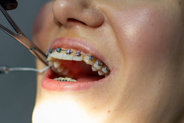 istock A woman at a dentist's appointment to replace arches with braces. 1285401803