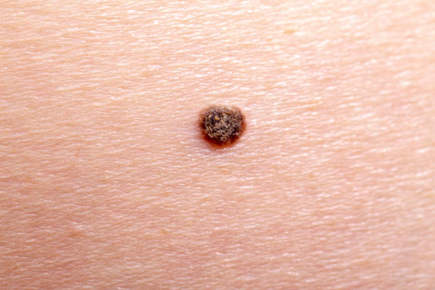 istock The initial stage of melanoma 1285478809