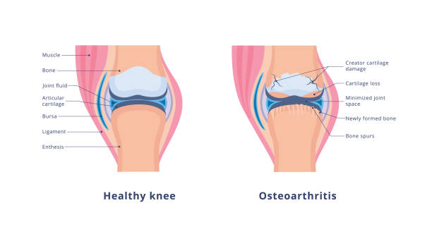 무릎 관절염과 정상적인 관절과 의료 해부학 벡터 배너 - cartilage patella human knee medical exam stock illustrations