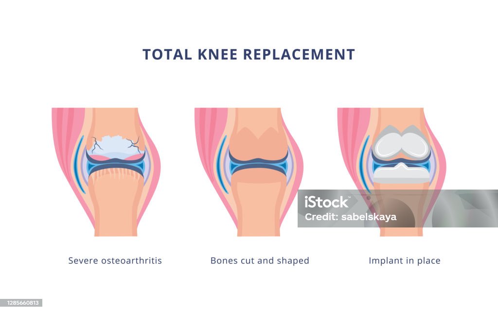 Knee Replacement Process Total Knee Replacement Surgery Procedure Flat Vector Illustration ...