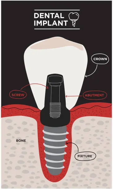 Vector illustration of Dental implant structure. Medical educative infographic. Dental Implant Information