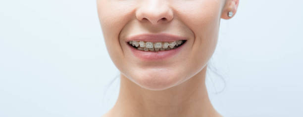 weibliches lächeln mit zahnspangen. behandlung von menschlicher maloklusion - fehlbiss stock-fotos und bilder