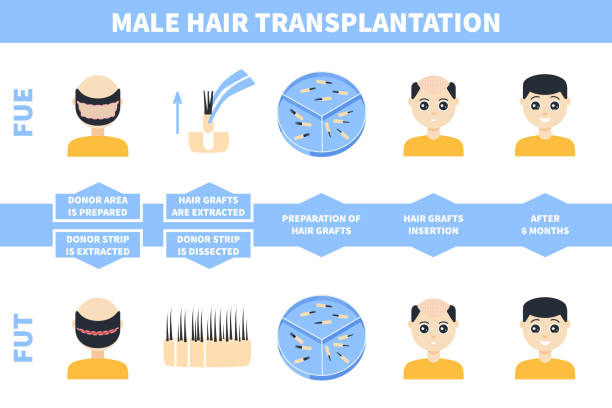 ilustrações, clipart, desenhos animados e ícones de transplantação de cabelo masculino com fue, métodos fut - alopecia homem