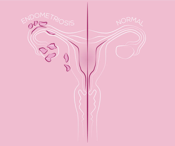 Illustration of endometriosis, endometrial tissue Illustration of endometriosis, endometrial tissue in the uterus, female disease, womens medicine endometriosis stock illustrations