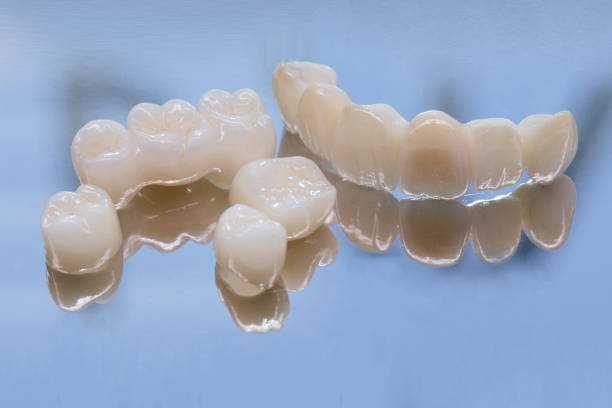 metallfrei keramik dental kronen. keramik-zirkonium in der endversion. färbung und verglasung. präzisionsdesign und hochwertige materialien - zahnkrone stock-fotos und bilder