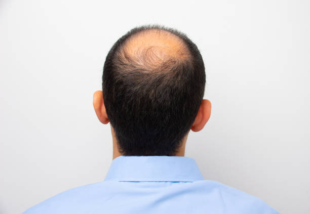 homme avec l’alopécie - balding photos et images de collection