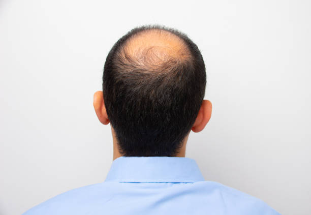 man with alopecia Rear view of a male head with thinning hair or alopecia balding stock pictures, royalty-free photos & images