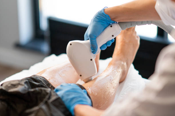 istock Laser Hair Removing Epilation on legs 1286143254