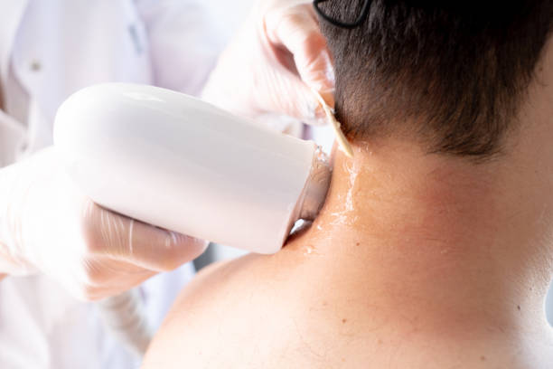 istock Laser Hair Removing Epilation on man's neck and shoulder 1286143463
