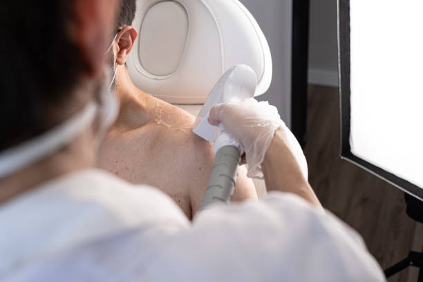 istock Laser Hair Removing Epilation on man's neck and shoulder 1286143574