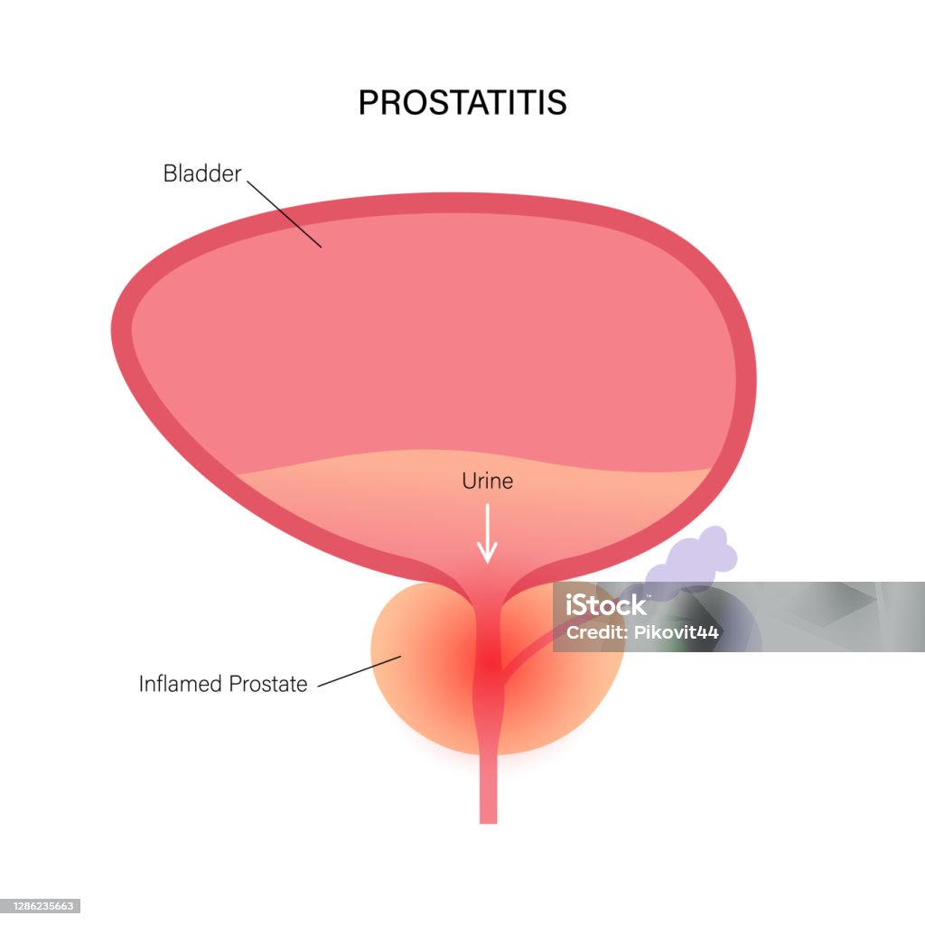 Prostatitis Inflammation Problem Stock Illustration - Download Image ...