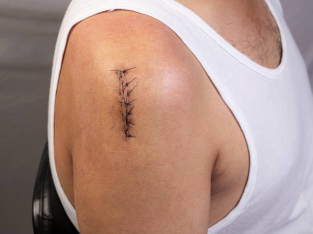 istock Surgical incision on right shoulder joint closed with sutures 1286248895