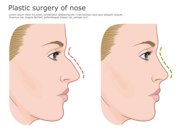 ilustrações, clipart, desenhos animados e ícones de cirurgia plástica do nariz - nose job illustrations