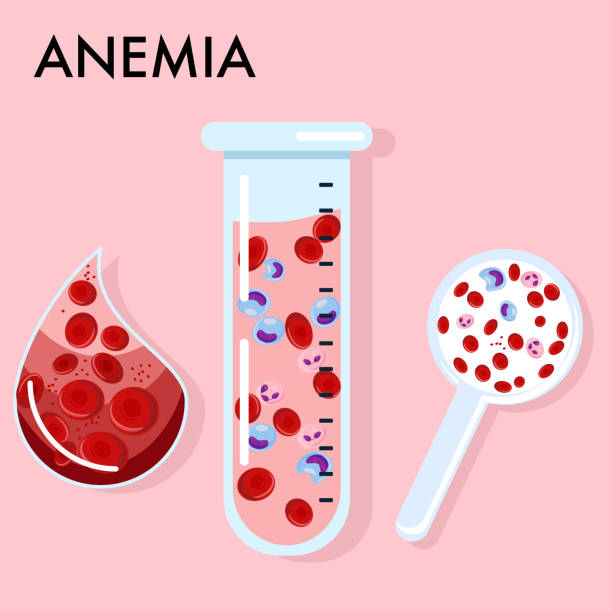 Anemia concept.Glass laboratory test tube and magnifier with blood analysis.Decrease of Erythrocytes or low hemoglobin.Iron deficiency in serum.Leukocytes,neutrophil.Drop with red cells. Medical vector poster. Pink. Flat style photographic chemistry stock illustrations