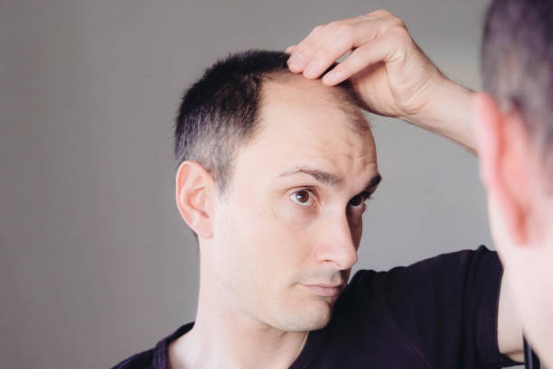 männliche muster haarausfall problem konzept. junger kaukasischer mann, der auf spiegelliche sorgen über glatzenbildung schaut. kahlheit, alopezie bei männern. - glatzenbildung stock-fotos und bilder