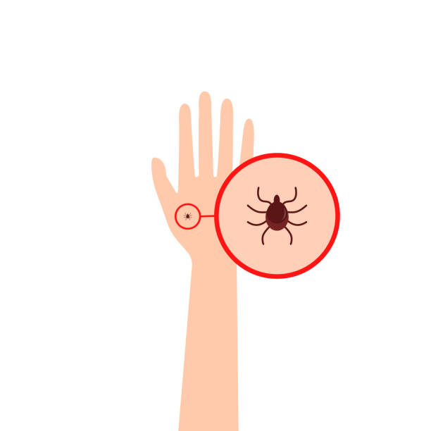 hand with a tick under a magnifying glass hand with a tick under a magnifying glass. concept of search insect on arm. educational skin infestation scheme. infected epidermis mite symptoms. flat design isolated on white background bug bite stock illustrations