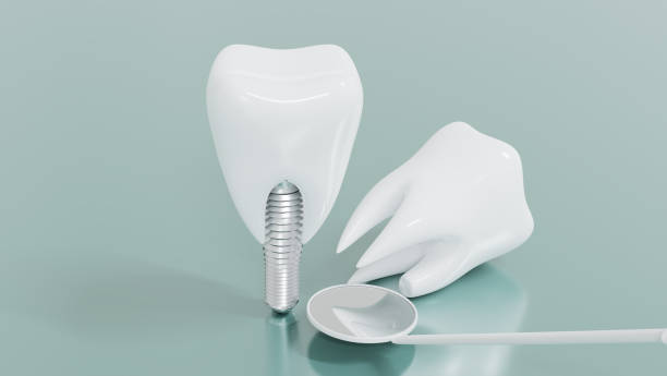 istock Dental Implants surgery concept, dentistry denture, Dental denture on green background. 3D render. 1286847927