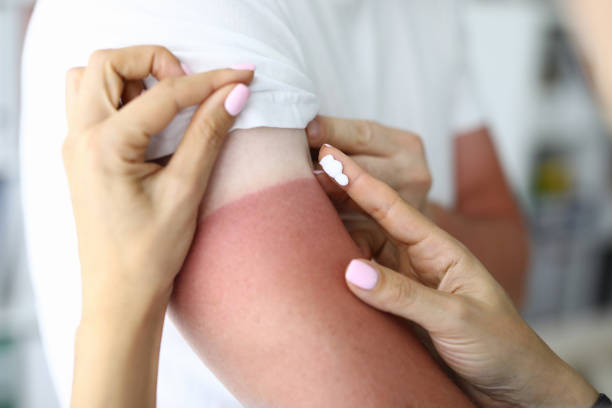 las manos de las manos de las mujeres aplican crema de quemaduras a lesiones de la piel. - quemado por el sol fotografías e imágenes de stock